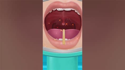 How To Treat Throat Tonsillitis Surgery Operation Carewithcare
