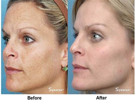 Fotofacial Treatment Your Face In A New Light Comprehensive