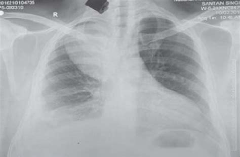 Chest Radiograph Postero Anterior View Showing A Homogeneous Opacity
