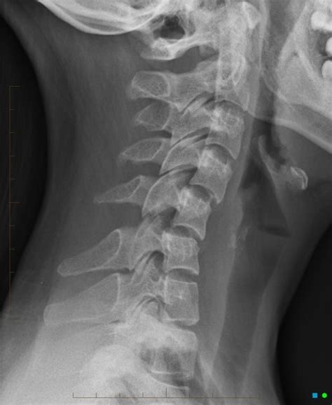 Bilateral Perched Cervical Facet Joints Hyperflexion Injury Perched