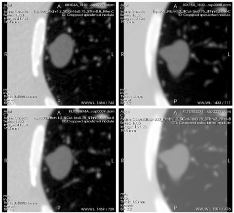 Example Scans Of A Spiculated Nodule Of −630hu Density And 20 Mm
