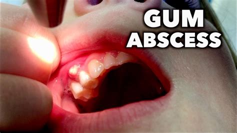 Gum Abscess Dr Paul Youtube
