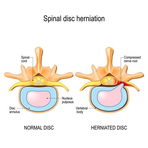 what you need to know about herniated disc treatment