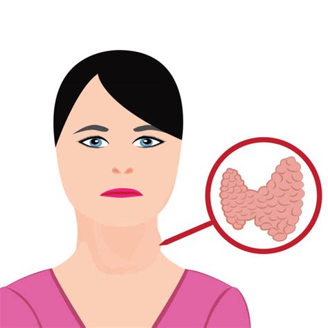 20 Hypothyroidism Symptoms In Women Illustrations Royalty Free Vector