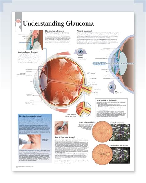 Understanding Glaucoma Exam Room Anatomy Poster Clinicalposters