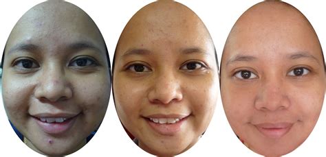T3 pimple gel for first sign of pimple (3 x 15g). Nurul ngerepak: Acne product reviewed!!! With pictures!!