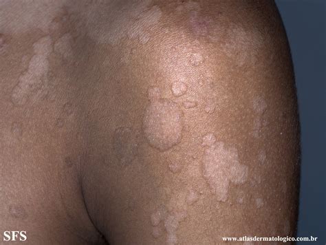 Sintomas De Pano Branco