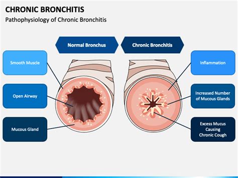 Chronic Bronchitis Powerpoint Template Ppt Slides