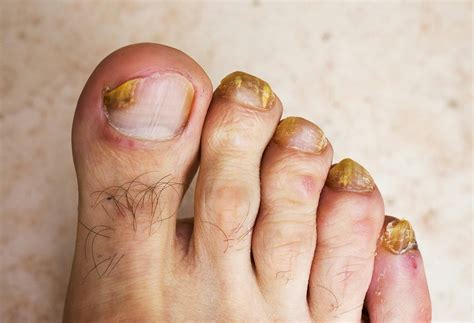 Nurses Know That Home Remedies Knock Out Nasty Nail Fungus The People