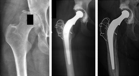 Thirty Five Year Results After Charnley Total Hip Arthroplas Jbjs