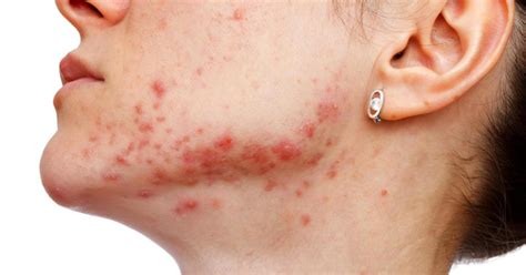 What Is Cystic Acne With Pictures