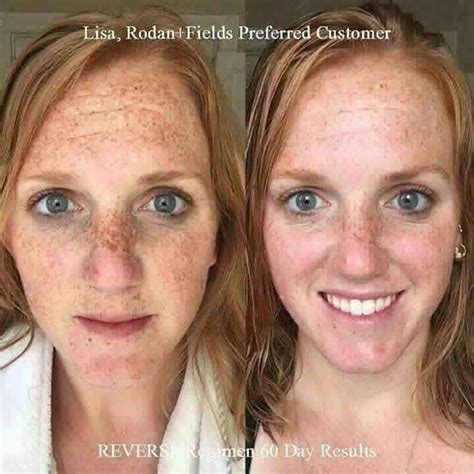 Yes Freckles Are The Result Of Sun Damage They Are Not Permanent