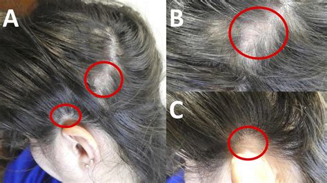 What Is Alopecia Hair Loss Alopecia Areata What Is It Symptoms Causes