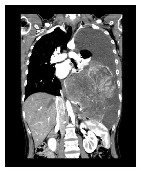 A Chest Contrast Enhanced Computed Tomography Ct Showing The Bulky