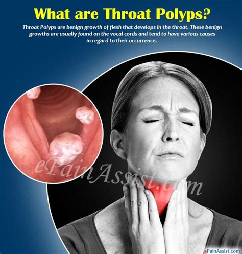 What Is Throat Polypscausessymptomstreatmentdiagnosis