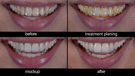 Smile Design Makeover ~ Dr Bharat Katarmal Dental And Implant Clinic