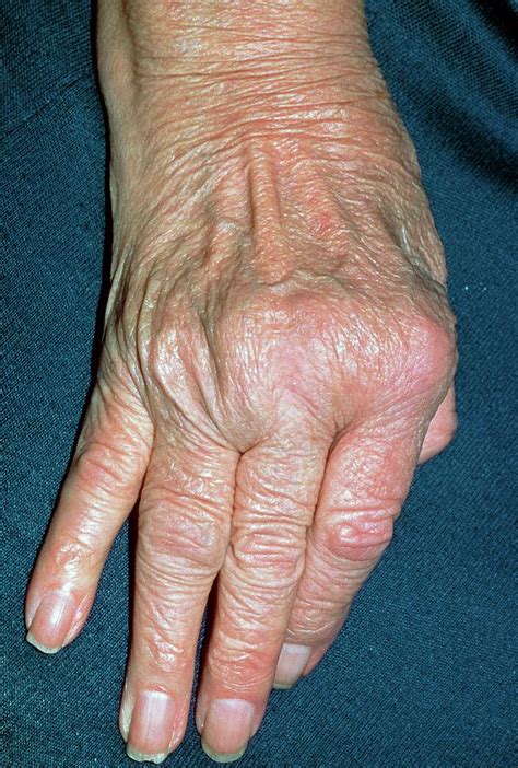 Rheumatoid Arthritis Of Hand With Ulnar Deviation Photograph By Science Photo Library