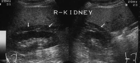 Cochinblogs A Sonographic Picture Review Of Renal Pathology