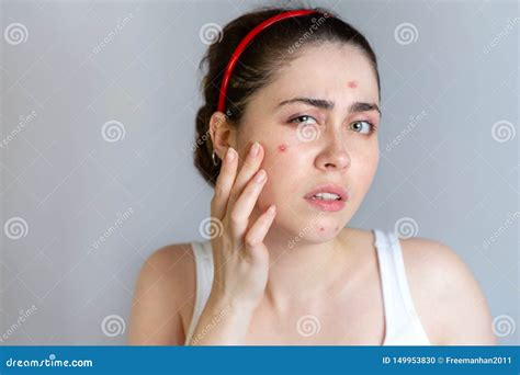 Young Cute Brunette Woman Examines Her Face With Pimples The Concept