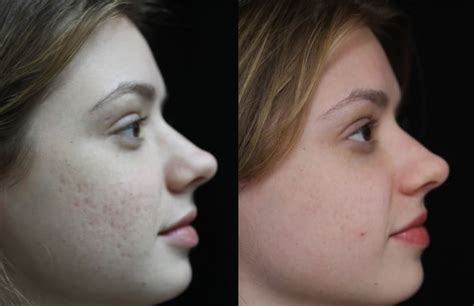 Acne Scar Removal Methods Michele Green Md