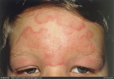 Stock Image Close Up Of Urticaria Hives Showing An Acute Urticarial Reaction With Large Red