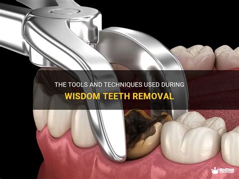 The Tools And Techniques Used During Wisdom Teeth Removal Medshun