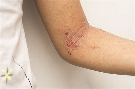 Penyebab Dermatitis Atopik Alodokter