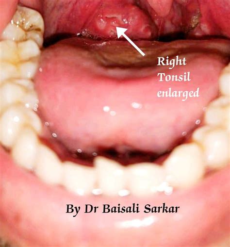 What Causes Unilateral Tonsil Enlargement In Children And Adults Is It