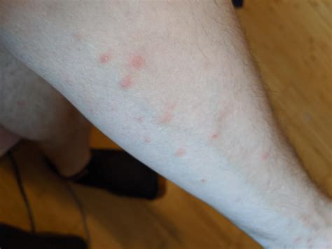Red Dry Spots All Over Body Askdocs