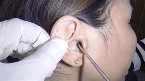 Most Massive Nasty Earwax Removal Youtube