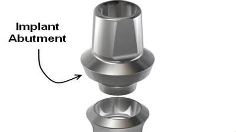 Dental Implant Abutment Definition Uses Types Procedures