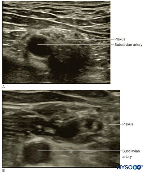 Ultrasound Guided Interscalene Brachial Plexus Block Nysora