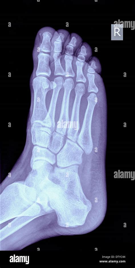 Radiographie d un pied montrant une fracture dans le 5ème d un