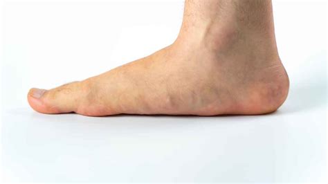Flat Feet Adams Foot And Ankle Surgery