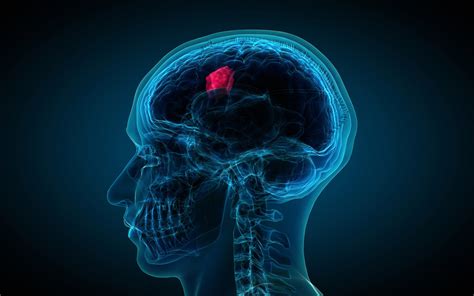 Common Types Of Brain Tumors Front Range Spine And Neurosurgery