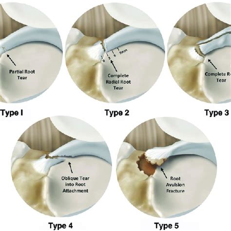 Transtibial Pull Out Repair Of A Medial Meniscal Posterior Root Tear In