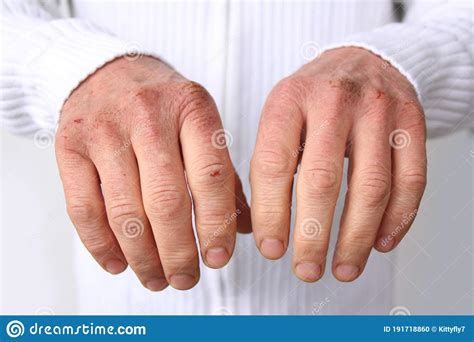 Close Up Of Male Hands With Dry Skin Damage Dermatology Concept Human