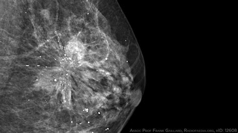Triple Negative Breast Cancers Not All The Same Medpage Today