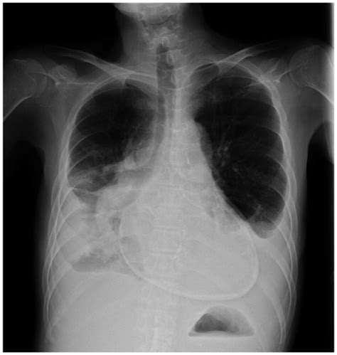 Pericardial Calcification In A Patient With Constrictive Pericarditis