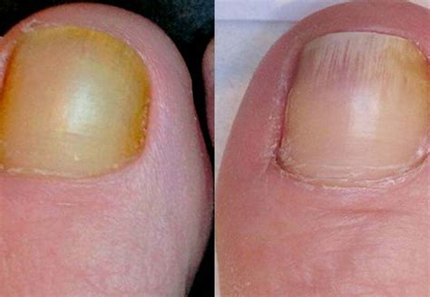Nail Fungal Infection Treatment In Bradford