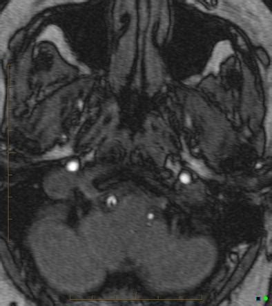 Vertebral Artery Dissection Radiology Reference Article Radiopaedia Org