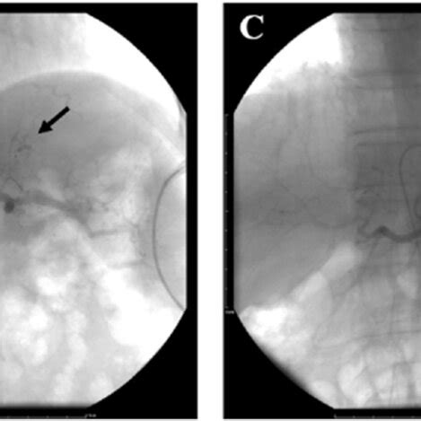 Left Gastric Artery Hemorrhage Embolism Diagram For Patient 2 A Celiac