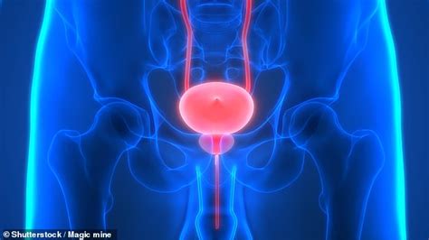 Why Arent Doctors Warning Women With Bladder Cancer That Surgery Cure