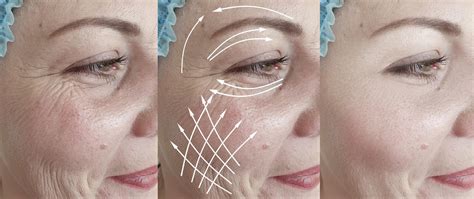 Woman Face Wrinkles After Effect Therapy Saggy Tension Plastic Difference Correction