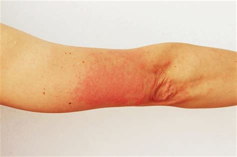Maculopapular Rash Hiv Symptoms