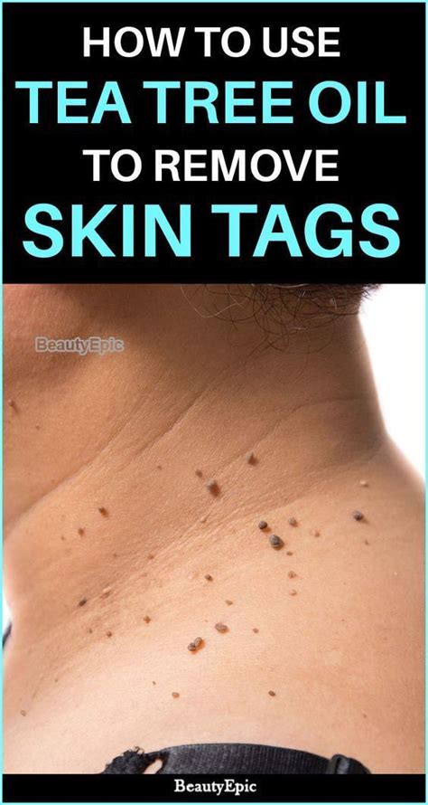 how to use tea tree oil to remove skin tags how to prevent skin