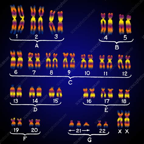 Female Karyotype Showing Downs Syndrome Stock Image C0219838