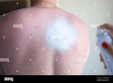Sun Burnt Tan Sunbathing Hi Res Stock Photography And Images Alamy