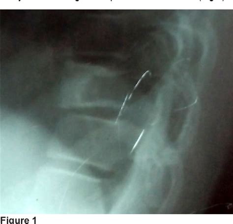 Figure 1 From Solid Variant Of Aneurysmal Bone Cyst Involving The
