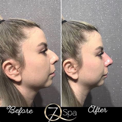 Before And After Gallery 7q Spa Laser And Aesthetics